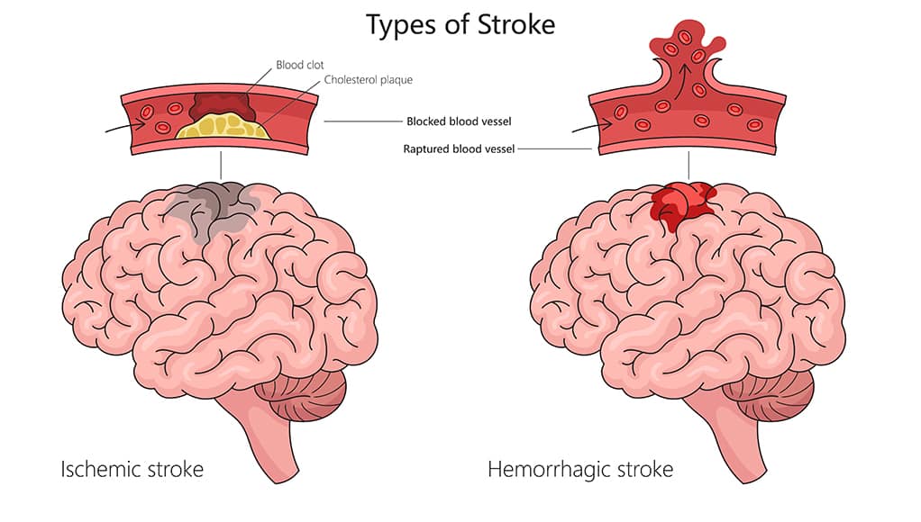 A cartoon brain with a blocked blood vessel and a brain with an aneurysm depicting the two types of stroke.