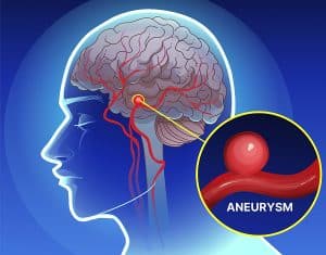 Graphic of a person's brain with an inset of an aneurysm.