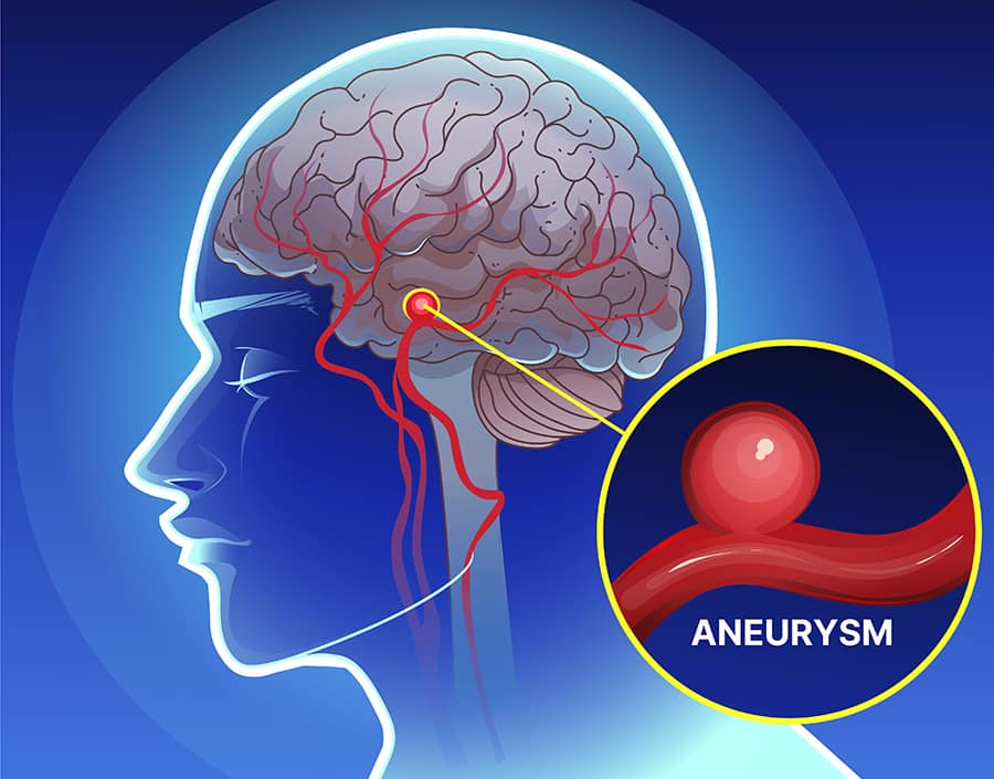 Graphic of a person's brain with an inset of an aneurysm.